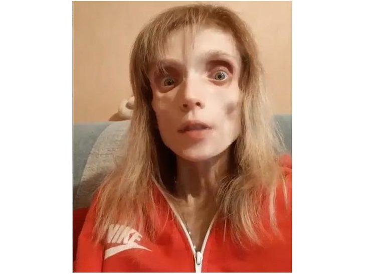 Anoreksiya hastası kadın sadece 17 kilo! G5