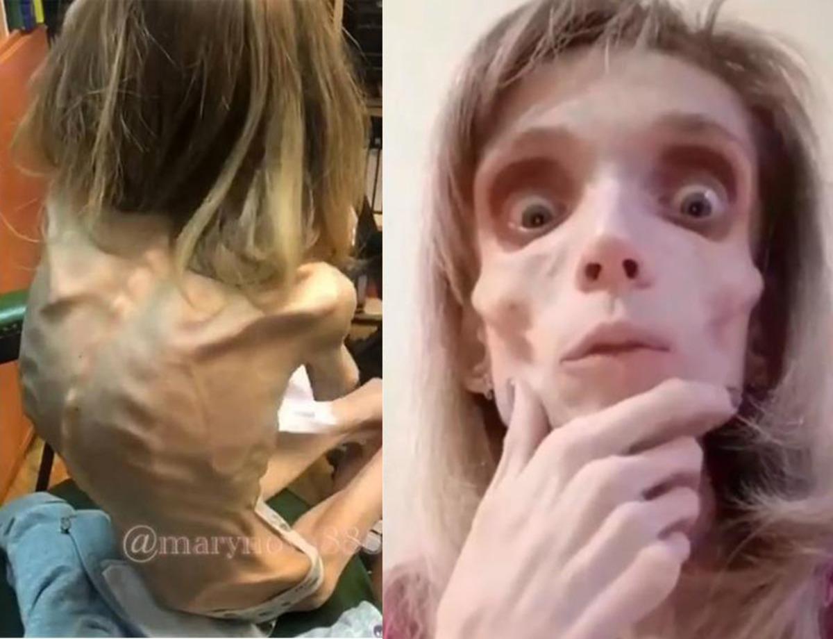 Anoreksiya hastası kadın sadece 17 kilo!