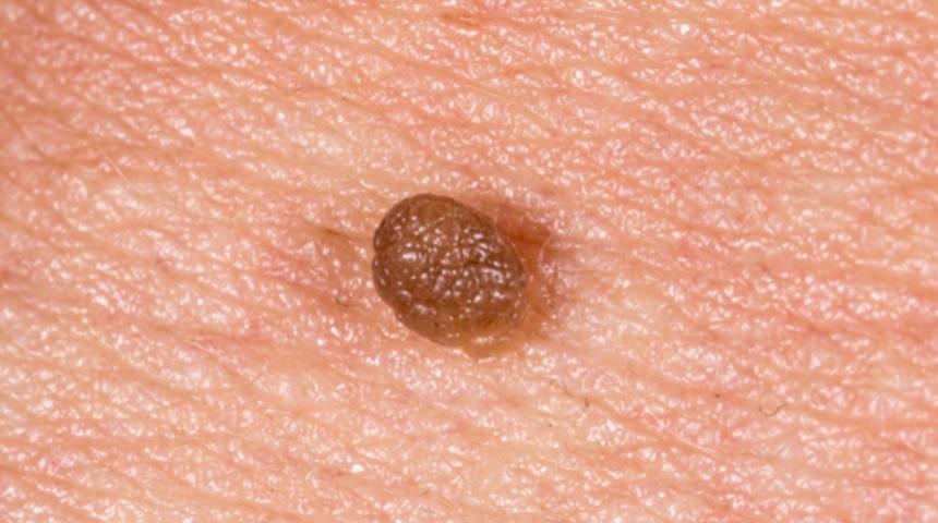 Genital siğilleri hafife almayın! Kanserin habercisi olabilir!