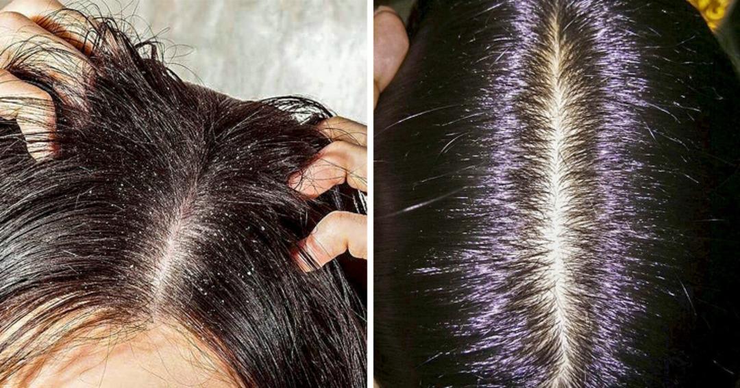 Kaşıntılı sa&ccedil; derisinden kurtulmak isityorsanız, işte bilmeniz gerekenler 