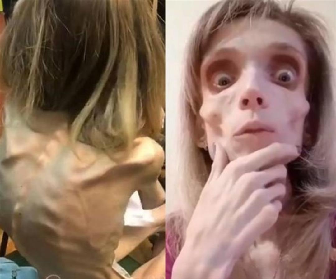 25 yaşında ama sadece 17 kilo 