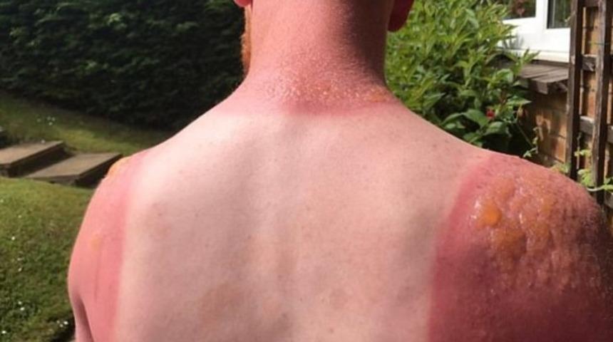 Güneş yanığına ne iyi gelir? Güneş yanığı evde doğal ve bitkisel yöntemlerle en hızlı nasıl geçer? 