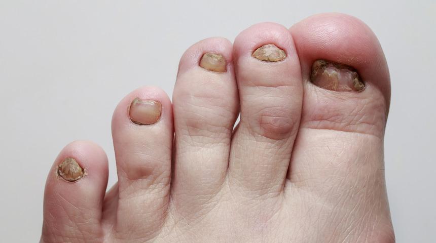 Tırnak batmasını &ouml;nlemek i&ccedil;in 7 altın kural