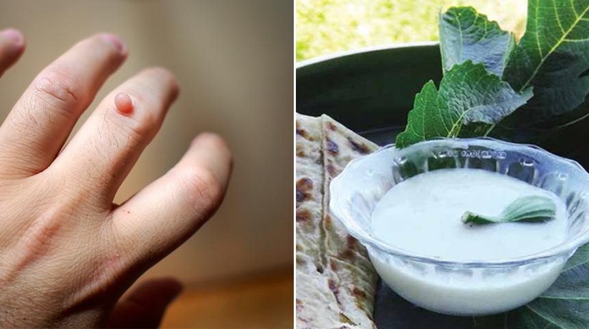 Siğilleri k&ouml;k&uuml;nden s&ouml;k&uuml;p atar! İncir s&uuml;t&uuml;n&uuml;n sağlığımıza kattığı faydalar