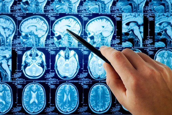 Unutkanlığı Alzheimer'dan ayıran 10 unsur  G3