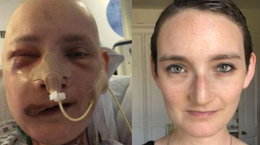 'Yüz rekonstrüksiyon ameliyatı hayatımı değiştirdi'