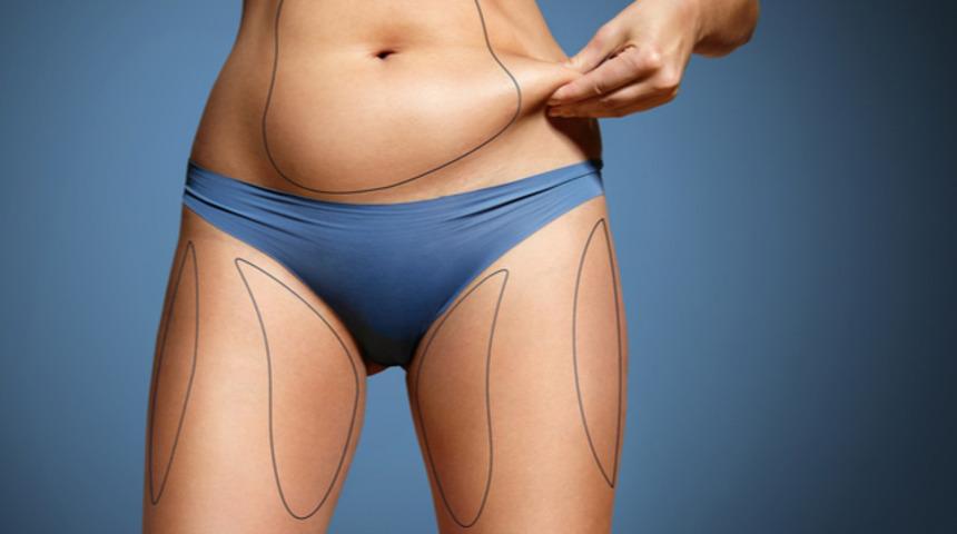 Liposuction i&ccedil;in en uygun zaman ne zaman?