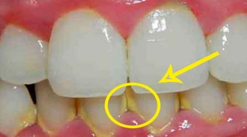 Diş&ccedil;iye gitmeden diş taşlarınızı yok edebileceğiniz doğal karışım