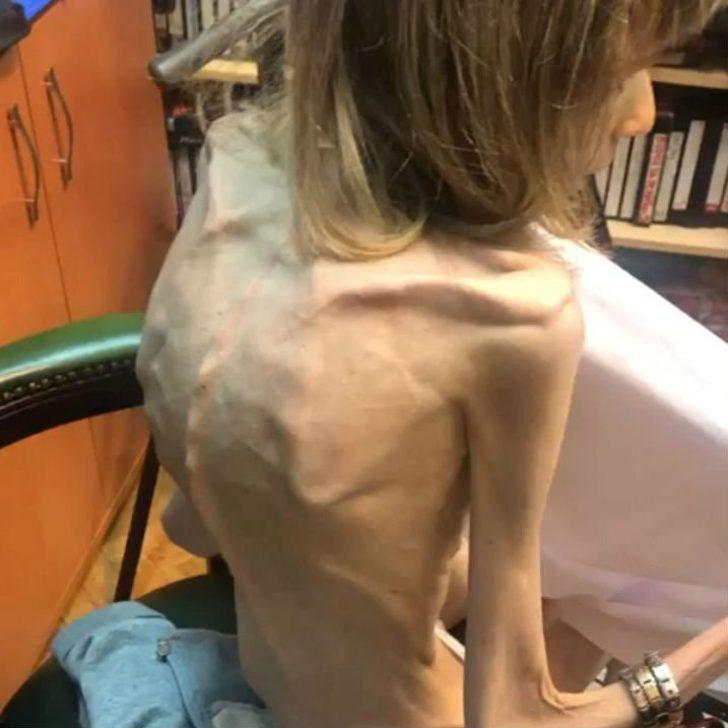 Tedavi olmazsa ölecek! Sadece elma ve muzla beslenerek 17 kiloya düştü G2