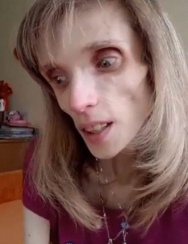 Tedavi olmazsa ölecek! Sadece elma ve muzla beslenerek 17 kiloya düştü G4