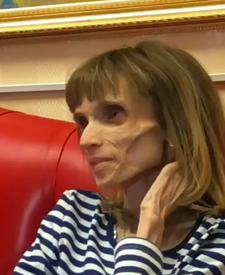 Tedavi olmazsa ölecek! Sadece elma ve muzla beslenerek 17 kiloya düştü G5