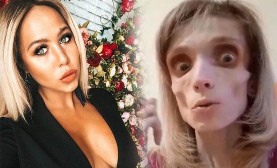 Tedavi olmazsa &ouml;lecek! Sadece elma ve muzla beslenerek 17 kiloya d&uuml;şt&uuml;