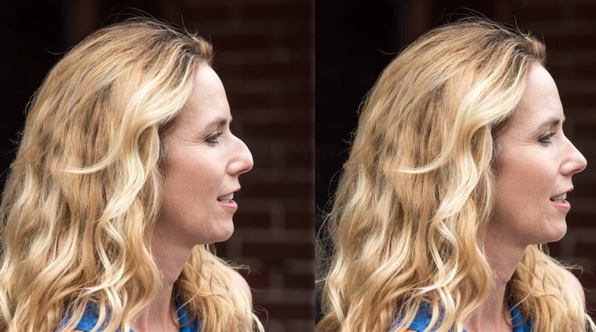 Burun estetiği hakkında doğru bilinen yanlışlar! 