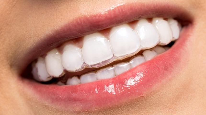 Diş teli tedavisi nasıl olur? Diş teli tedavisinde devrim! Görünmeyen diş teli nedir? 