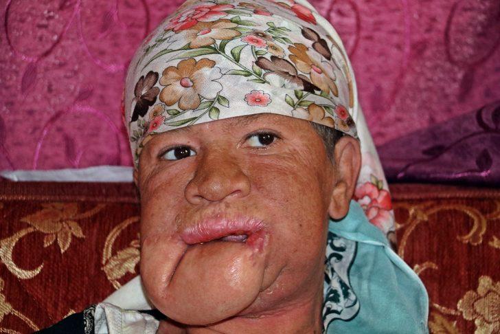 Çenesinde çıkan sivilce hayatını kararttı! G1