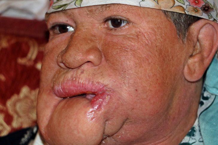 Çenesinde çıkan sivilce hayatını kararttı! G2