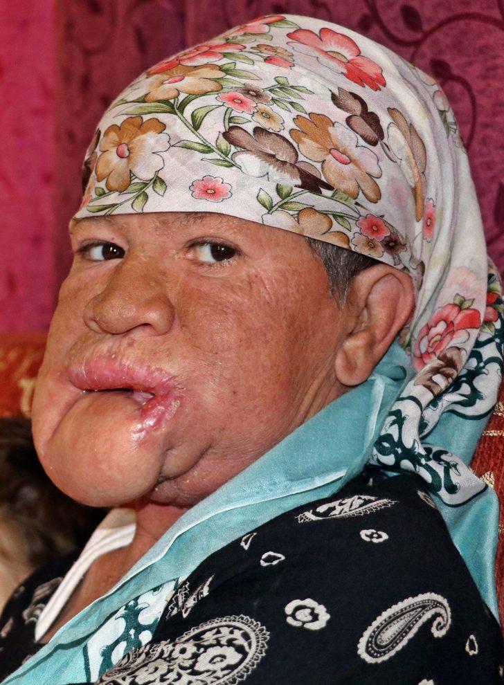 Çenesinde çıkan sivilce hayatını kararttı! G3