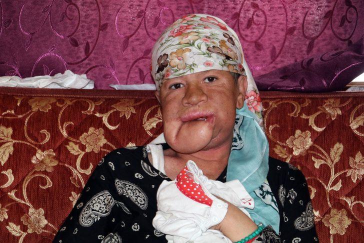 Çenesinde çıkan sivilce hayatını kararttı! G4