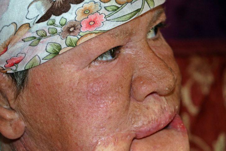 Çenesinde çıkan sivilce hayatını kararttı! G5