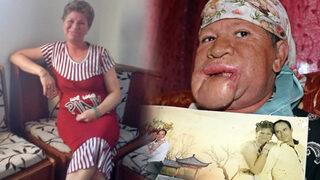 Çenesinde çıkan sivilceyi önemsemedi, hayatı karardı