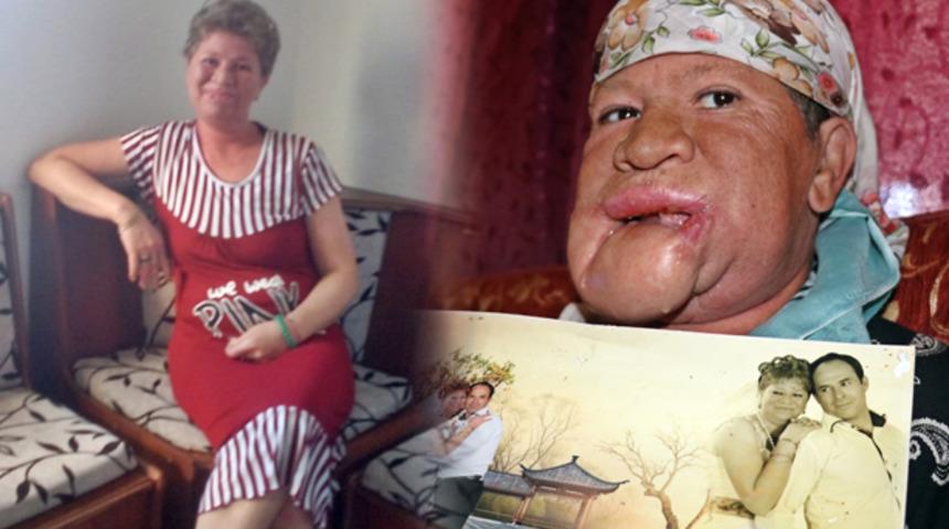 Çenesinde çıkan sivilceyi önemsemedi, hayatı karardı