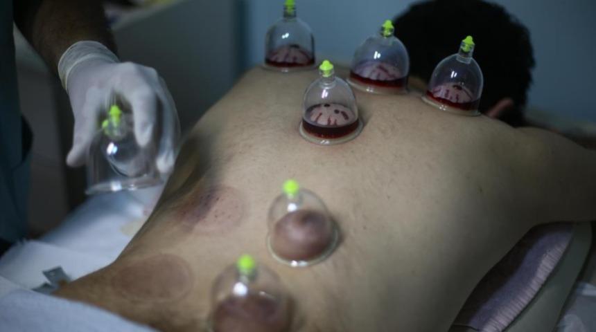 Hacamat nedir, nasıl yapılır? Hacamatın faydaları nelerdir? Hacamat hangi günler yapılır?