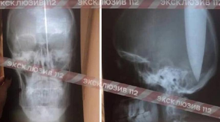 Rusya'da burnu tıkalı adam nefes almak i&ccedil;in bı&ccedil;akla kafasını deldi!