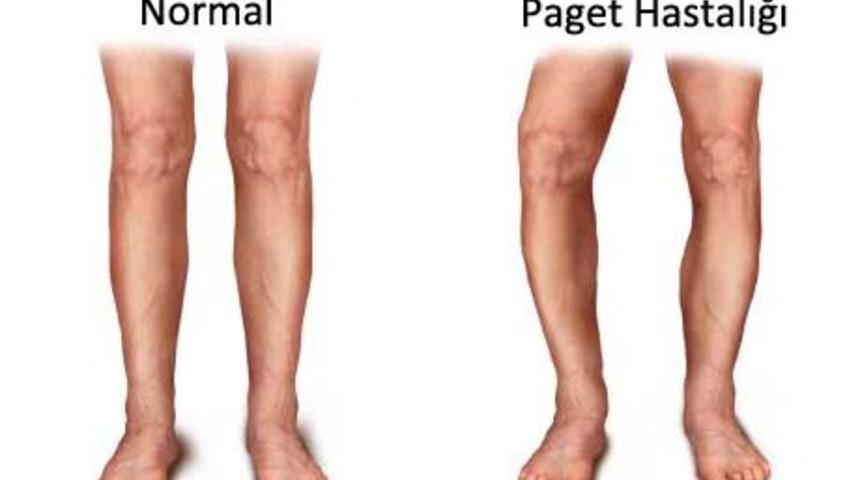 Bu hastalık kemikleri büküyor!