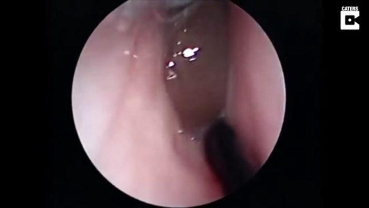 Burnundan çıkan şey şoke etti  G3