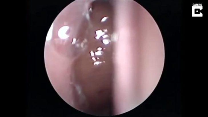 Burnundan çıkan şey şoke etti  G5