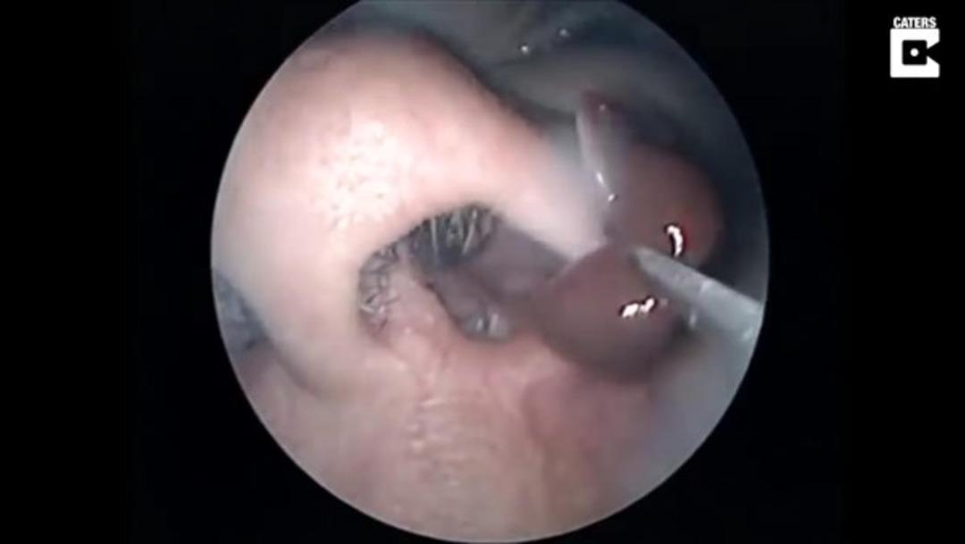 Burnundan &ccedil;ıkan şey şoke etti 