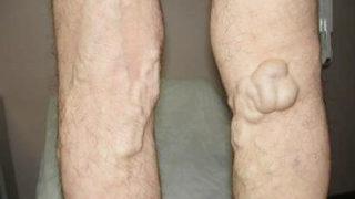 Varis nedir? Varis tedavisinde nelere dikkat edilmeli? Varis çorabı kullanırken nelere dikkat edilmeli?