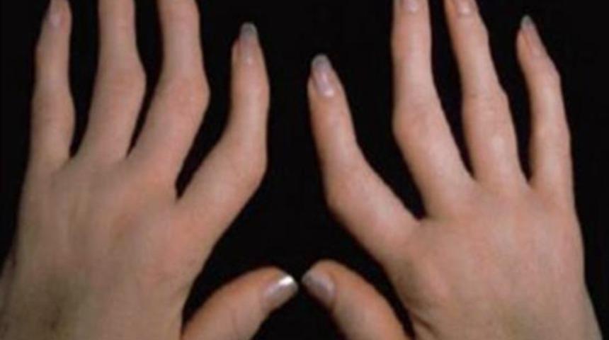 İltihaplı eklem romatizması yani artrit nedir? İltihaplı eklem romatizması tedavisi nasıl olur? İltihaplı eklem romatizması ilaçları tedaviyi hızlandırıyor