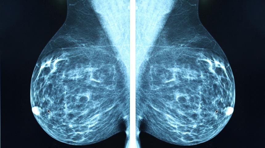 Google yapay zeka ile kanser teşhisinde doktorları gölgede bıraktı! Yüzde 99 doğru tanı