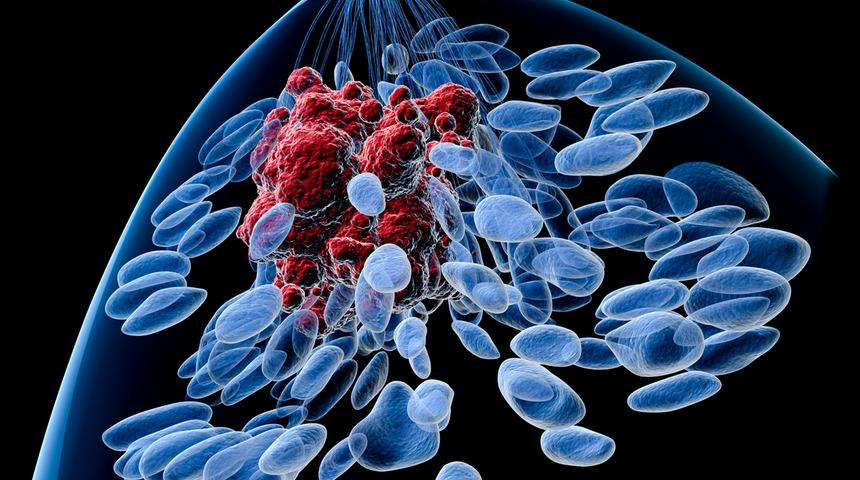 Meme kanserinin 6 önemli sinyali! Şişlikten kızarıklığa birçok belirti veriyor