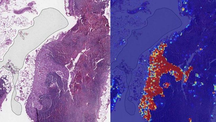 Google yapay zeka ile kanser teşhisinde doktorları gölgede bıraktı   G1