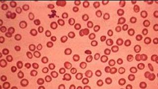 Türkiye'de 4 bin 513 Talasemi hastası var