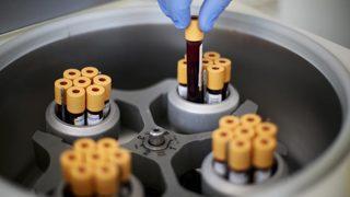 MCV nedir? MCV normal değerleri nelerdir? MCV düşüklüğü ve yüksekliği ne anlama gelir? 