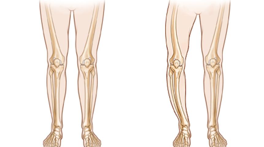 Kemiğin paget hastalığı nedir? Kemiğin paget hastalığı tedavisinde kalsiyum takviyesine dikkat