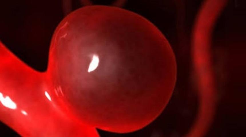 Anevrizma nedir? Anevrizma neden olur? Anevrizma belirtileri nelerdir? Anevrizma tedavisi yöntemleri nelerdir?