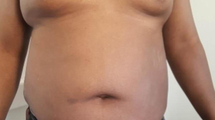 Kaybolan testis sendromu: İnce ses, çok küçük penis, büyük göğüsler, kalkık kalçalar