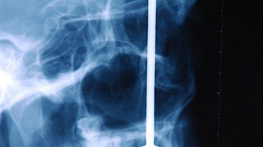 Gerçekten Olduğuna İnanamayacağınız 10 Tıp Vakası!