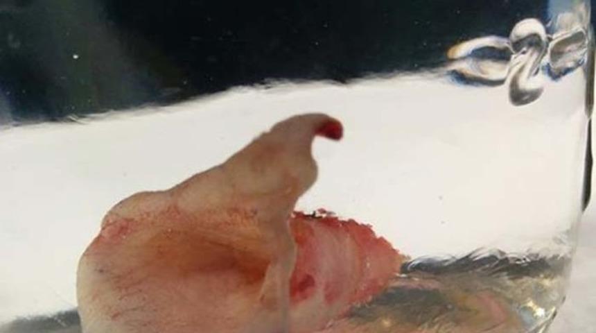 İşte G&ouml;bek Deliğiniz V&uuml;cudunuzdan Ayrılınca Bunun Gibi G&ouml;r&uuml;n&uuml;yor