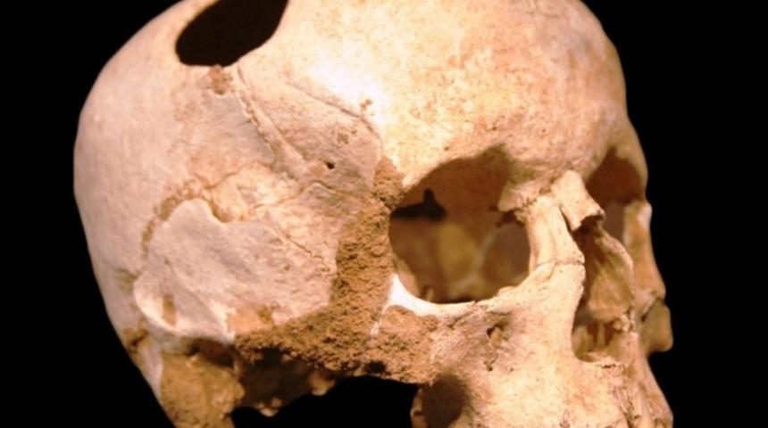 3000 Sene &Ouml;nce Anadolu'da Yapılan Beyin Ameliyatı!