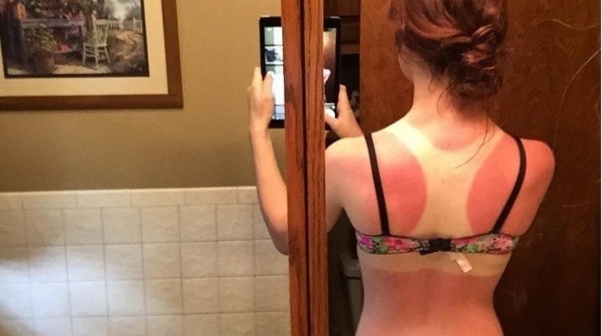 G&uuml;neşte Ger&ccedil;ekten 'Yanmış' 12 Instagram Kullanıcısı