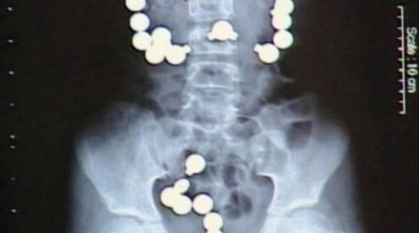 ''Nasıl &Ouml;lmemişler!'' Dedirten İnanılmaz Kazalar ve R&ouml;ntgen Filmleri