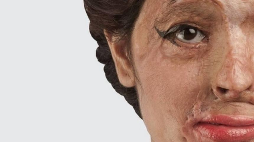 Kadına Şiddetin Hindistan Tarafı: Asit Saldırısından Canlı Kurtulan Reshma Quereshi