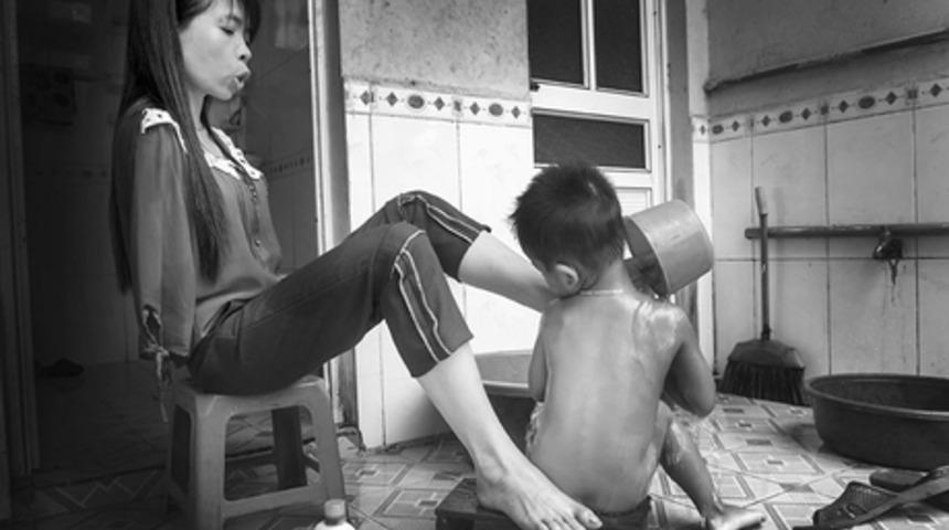 Savaşta Kullanılan Kimyasallar Yüzünden Kolları Olmadan Doğan Vietnamlı Nguyet