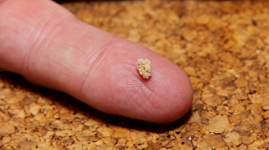 Böbrek Taşını Düşürmek İçin Alternatif Tıp: Sevişin!