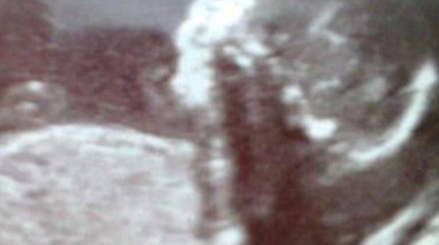 Gerçek Dünyada Bir Masal Kahramanı: Pinokyo Bebek